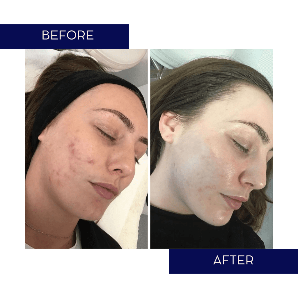 Real Patient Before and After Chemical Peel Result for Active Acne at Gerka Clinic Dublin