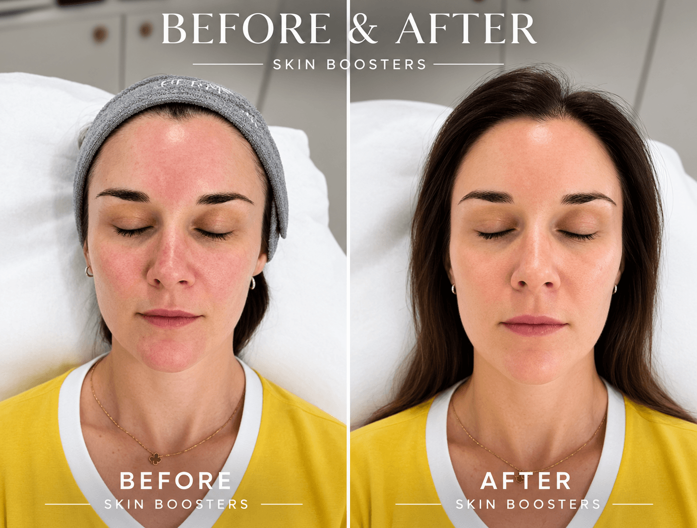 Real Patient Before and After Skin Booster Treatment Result at Gerka Clinic Dublin