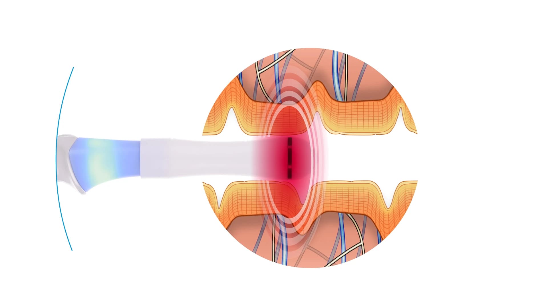 Exilis Ultra Femme 360 Thermal Radiofrequency Action Diagram