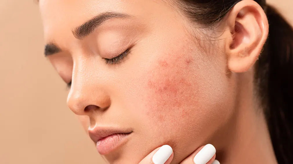 Clinical Acne Treatment