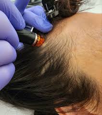 HydraFacial Clinical Detail