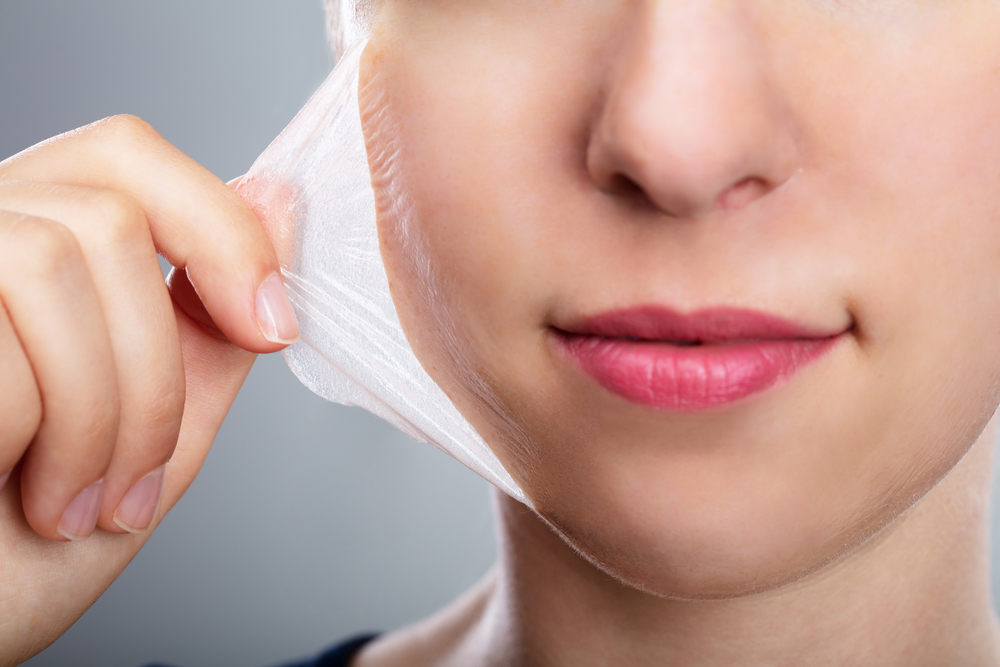 Medical-Grade Chemical Peel