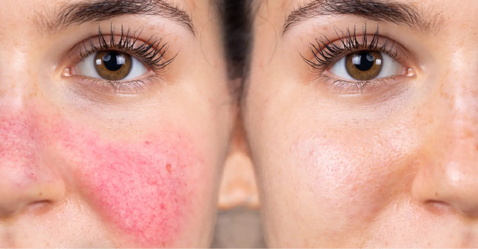 Rosacea Management